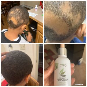 My Son Before and After Stages of Hair Growth